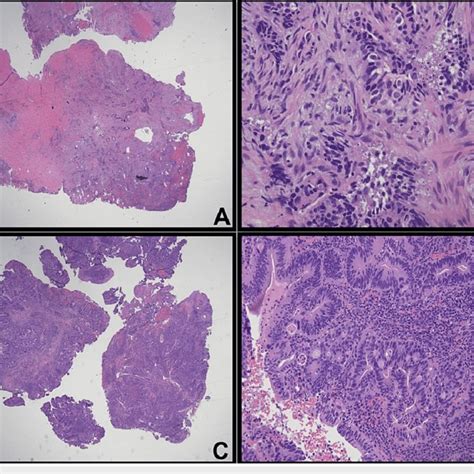 Hematoxylin And Eosin Hande Stains Of The Sections From The Biopsy Download Scientific Diagram