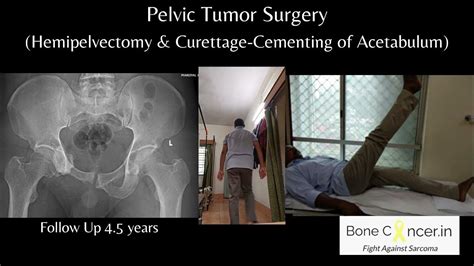 Treatment For Bone Tumour Giant Cell Tumour Pelvis Denosumab And Pelvis Surgery Dr Srimanth B