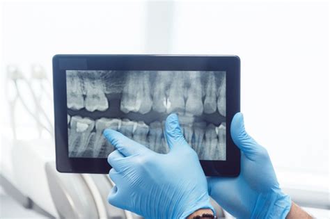 Reason For Dental X Rays Edison Signature Smiles