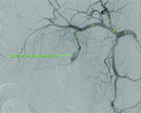 Pre Embolization Arteriogram Showing Cystic Artery Pseudoaneurysm A