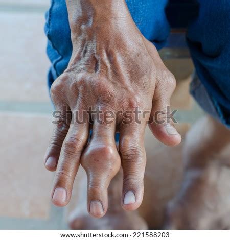 Gout Stock Photos, Images, & Pictures | Shutterstock