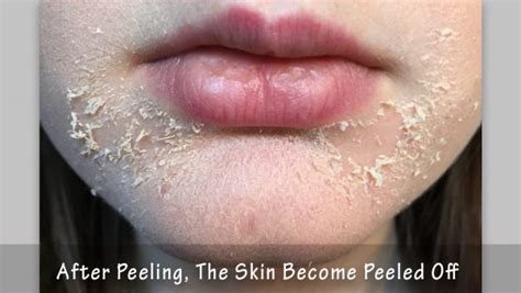 Peeling After Micro Needling Archives Richmond Hill Cosmetic Clinic