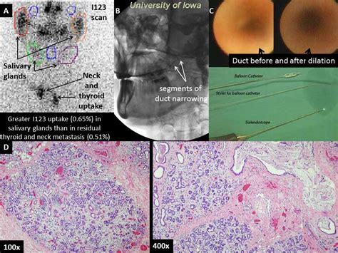 I131 Sialadenitis Radioiodine Sialadenitis Iowa Head And Neck Protocols