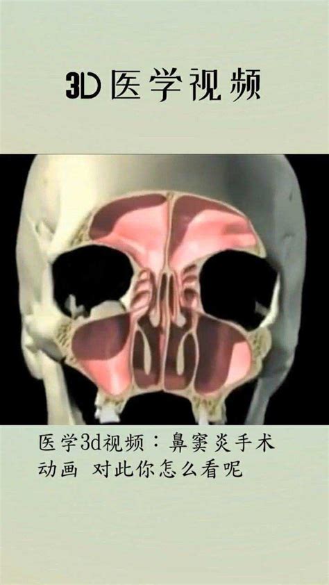 医学3d视频鼻窦炎手术动画对此你怎么看呢高清1080p在线观看平台腾讯视频