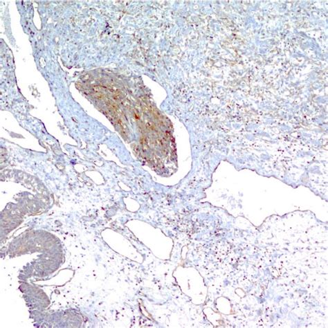 Immunohistochemical Staining For CD34 Revealed Staining Of Tumor Cells