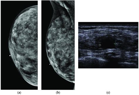 A 43-year-old woman with extremely dense breast tissue. Dense tissue ...