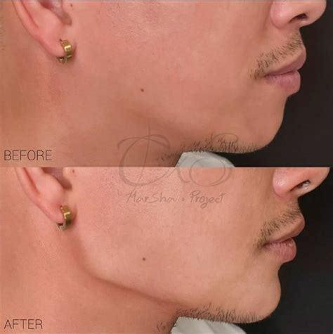 Non Surgical Jawline Sculpting Contouring Jawline Cosmetic