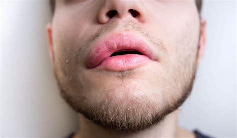 Angioedema hereditário o que é causas e sintomas Nav Dasa