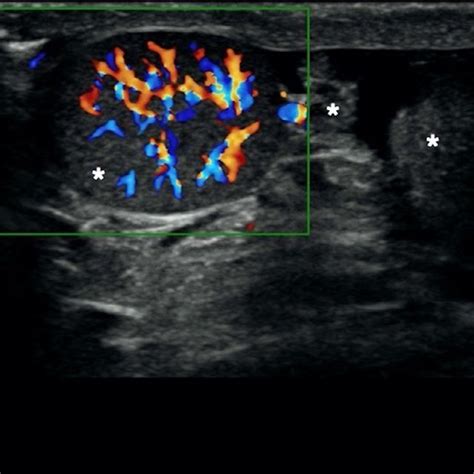 Transverse Ultrasound Image Of The Left Scrotum In A 29 Year Old Male Download Scientific