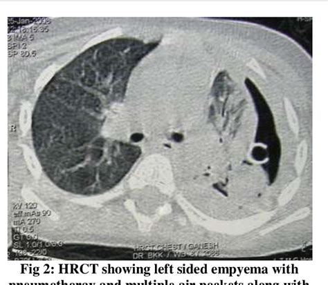 Figure From Lung Gangrene With Cavity Due To Tuberculosis Presenting