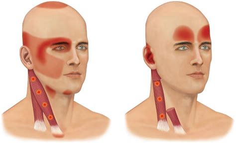 Temporomandibular Disorders Etiology And Classification Pocket Dentistry