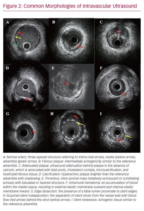 Common Morphologies Of Intravascular Ultrasound Radcliffe Cardiology