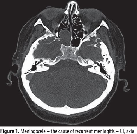 Table 1 From Isolated Sphenoid Sinus Pathologies The Problem Of Delayed Diagnosis Semantic