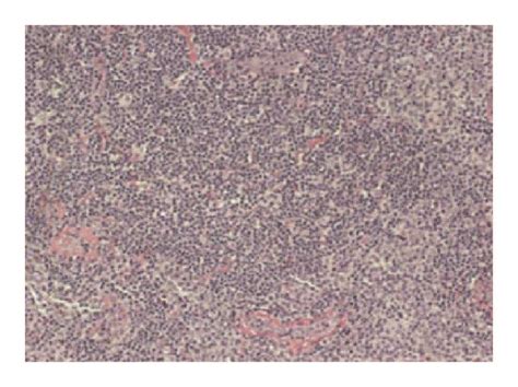 The Lymphoma Histological Image Samples For Different NHL Subtypes A