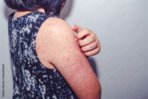 Blurred images of dermatitis from the measles virus, a woman with ...