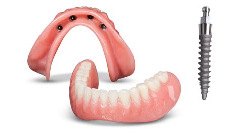 Mini Implant Overdenture Glidewell