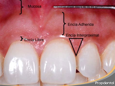 Tipos de encías Precio cuidar y tratar las encías inflamadas