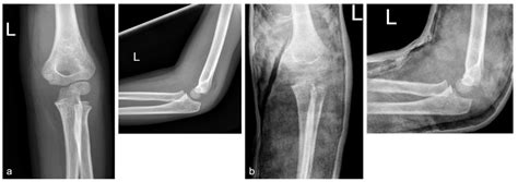 Correlation Of Fall Height Fracture Severity And Clinical Outcome In