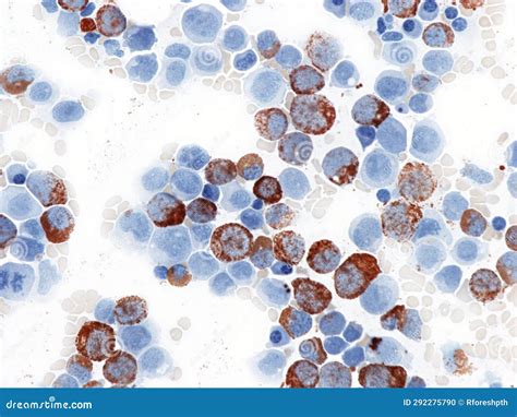 Myeloperoxidase Staining In A Case Of Acute Myeloid Leukemia Stock