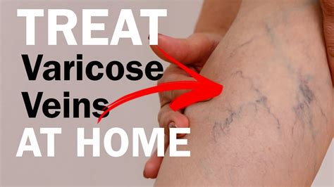 treating varicose veins  joint pains  home youtube