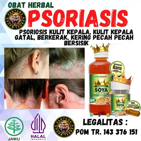 Jual Obat Psoriasis Kulit Kepala Kulit Kepala Gatal Berkerak Kulit