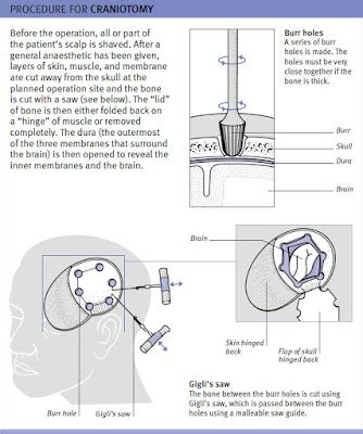 Procedure For Craniotomy ~ Nursing