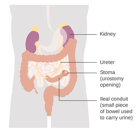 Urostomy | UCSF Ostomy Education Portal