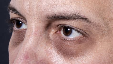 The Best Treatments For Under Eye Bags Dark Circles Hollowing