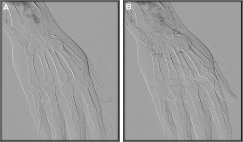 Distal Revascularization And Interval Ligation Procedure For Radial