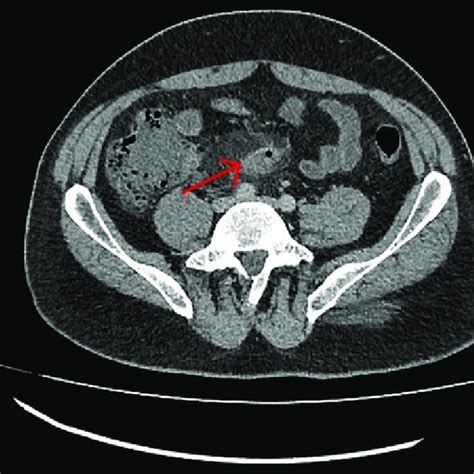 Ct Abdomen And Pelvis Showing Acute Appendicitis See Arrow Download Scientific Diagram