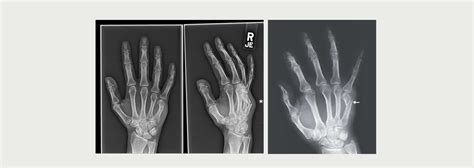 BOXER’S FRACTURE - MOTUS Physical Therapy