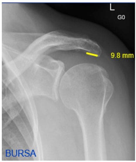 Jcm Free Full Text Acromial Morphology And Its Relation To The