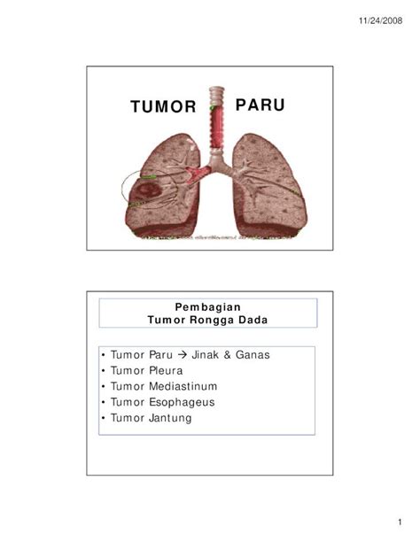 PDF Tumor Paru Power Point DOKUMEN TIPS