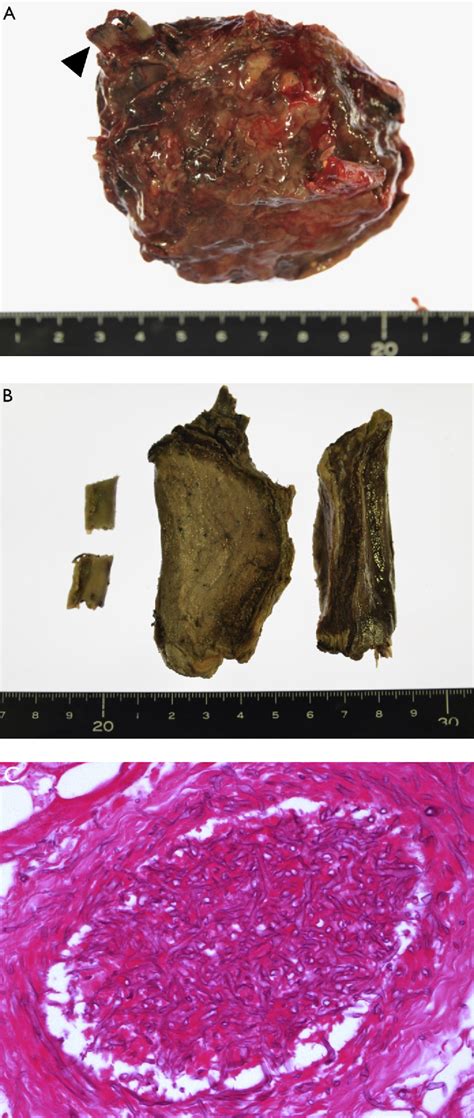 Figure 2 from A massive cavitary lesion invading the chest wall. | Semantic Scholar