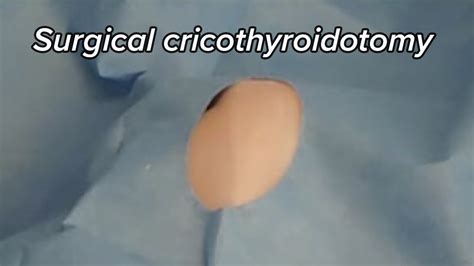 Surgical cricothyroidotomy - YouTube