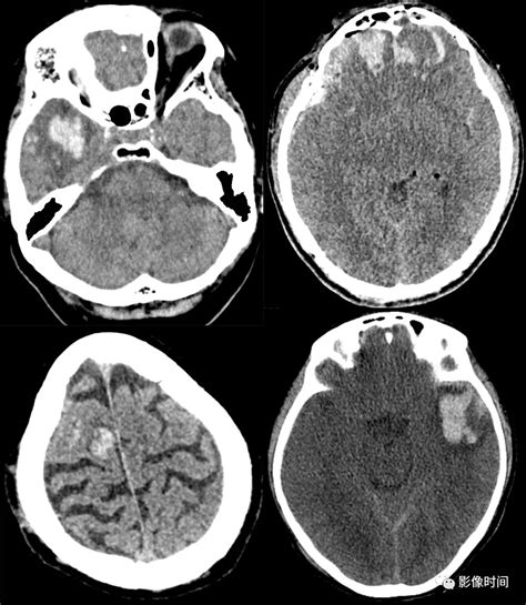 颅脑外伤的急诊 CT 表现看这篇就够了
