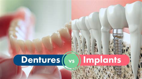 Dentures Vs Implants A Guide Flawless Dental