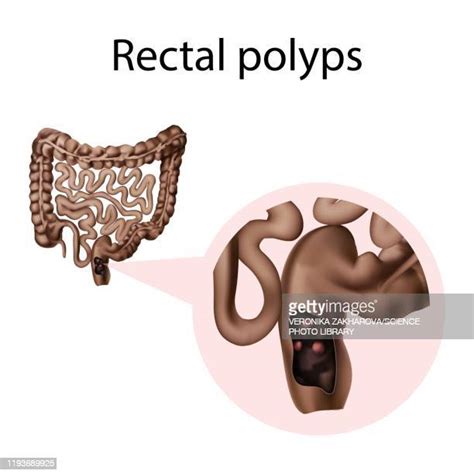 Rectal Medicine Photos And Premium High Res Pictures Getty Images