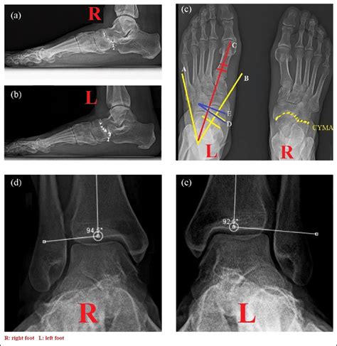 The Measurements For Ff Angles On The Anteroposterior And Lateral X Ray