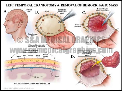 Neurosurgical Complications - S&A Medical Graphics