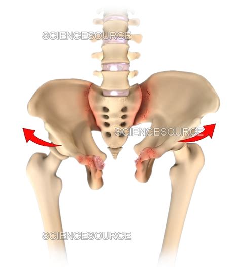 Open Book Pelvic Fracture Stock Image Science Source Images