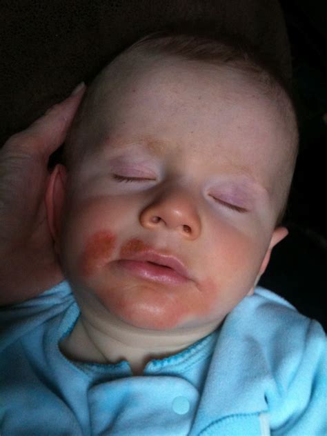 Autism Road to Recovery: Food Allergies - Xander's story