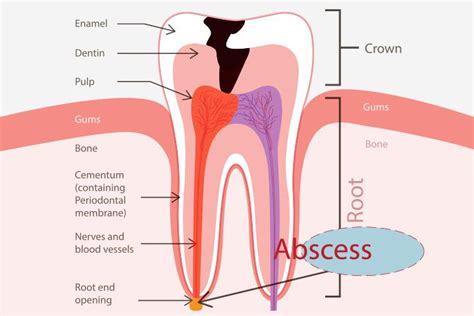 Tooth Abscess Stages Complications Symptoms And Causes Ekdantam Clinic