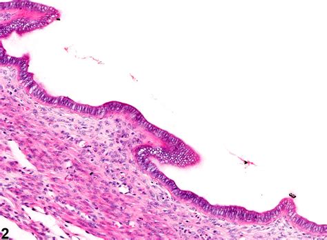 Uterus Dilation Nonneoplastic Lesion Atlas