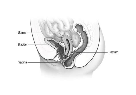 Pelvic Organ Prolapse Treatment