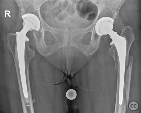 Vancouver B Periprosthetic Femur Fracture Lcp Broard Curved