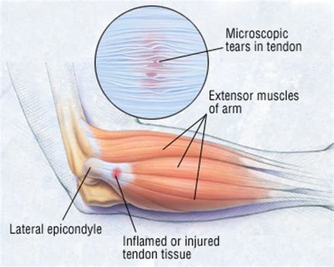 Elbow tendon injury - David Kummerfeld MD