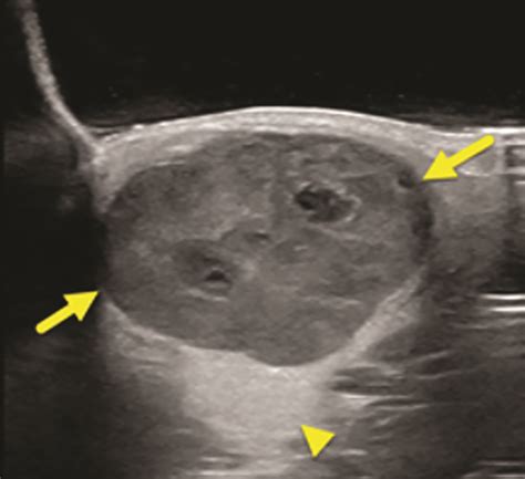 Pleomorphic Adenoma Of The Parotid Gland Applied Radiology