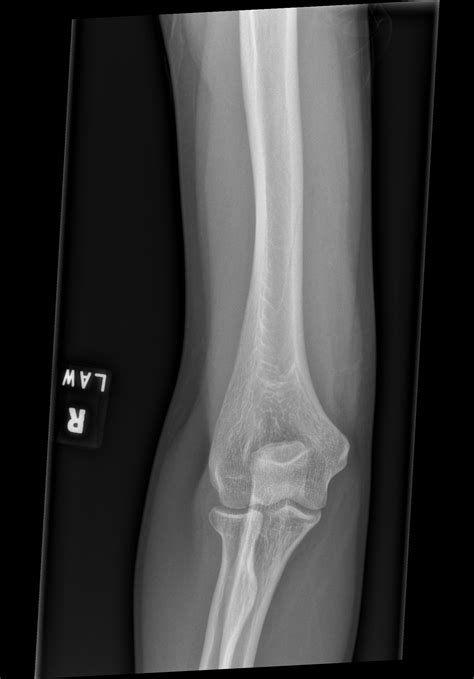 Radial Head Neck Fracture Radiology Case Radshare Net