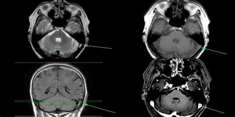 Brain Mr And Venography View Thrombosis In The Left Sigmoid Sinus